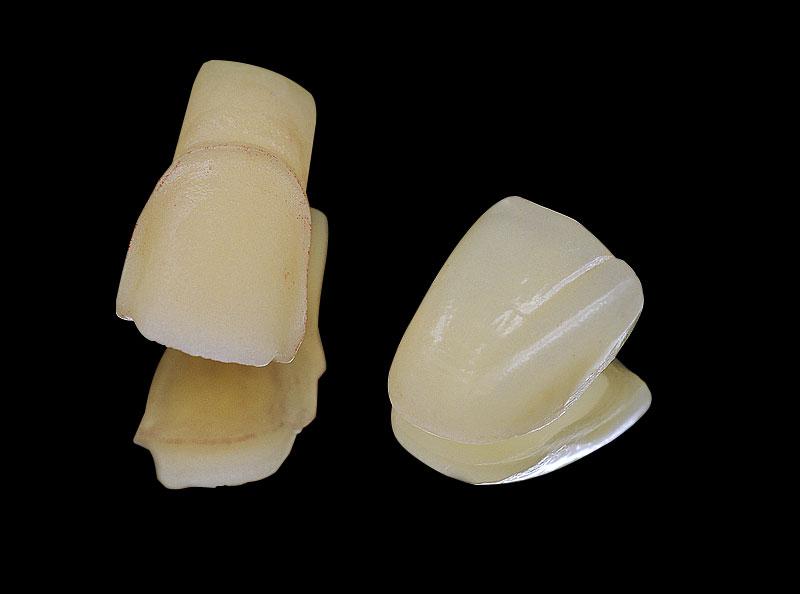 E.Max Crown Onlay