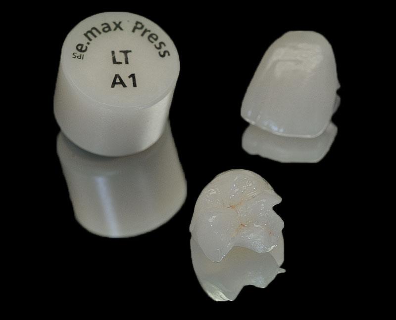 E.Max Crown Onlay