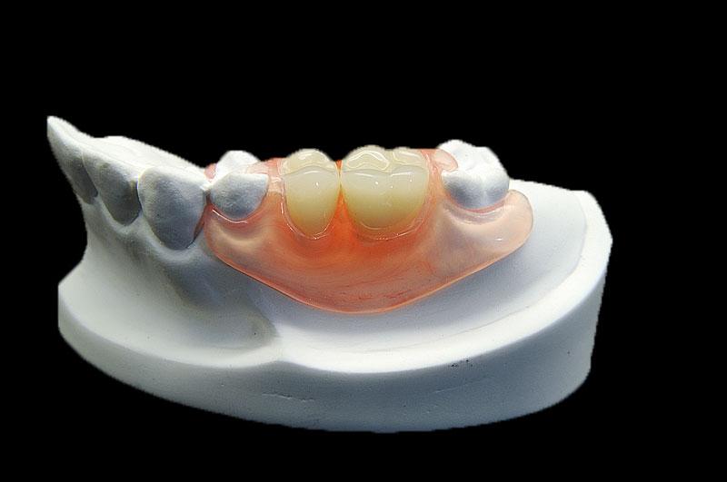Partial-Denture