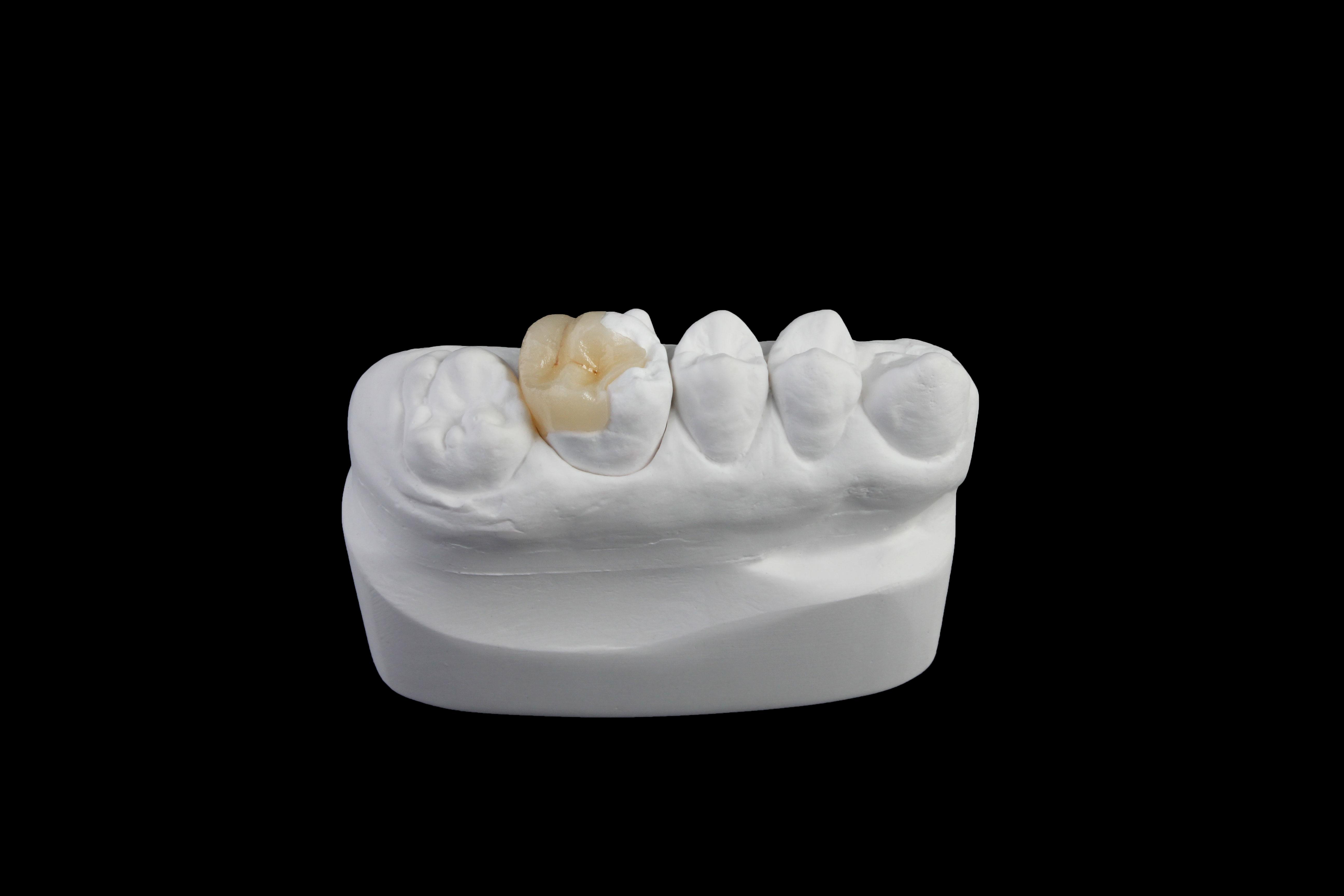 Full Zirconia