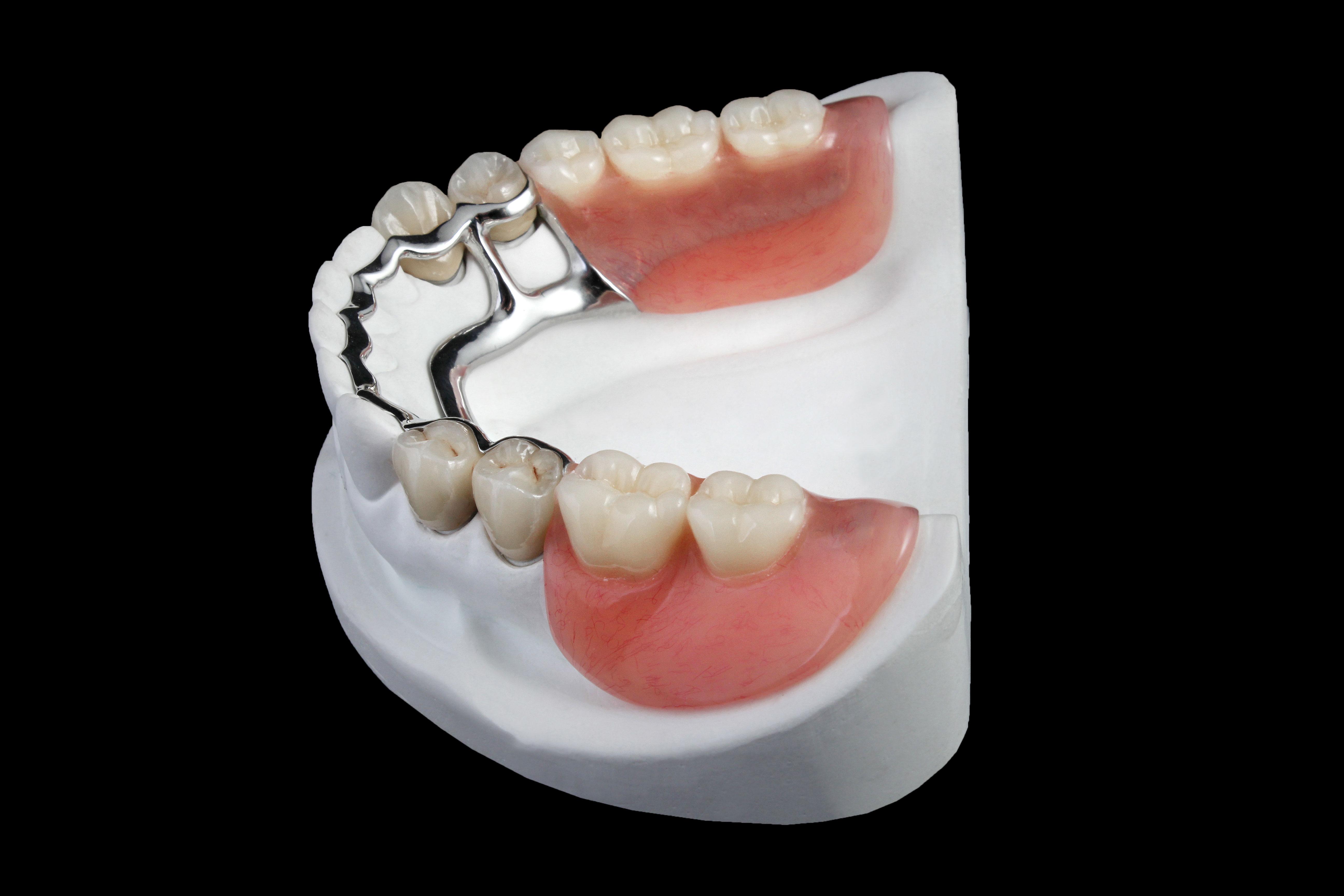 Framework+Acrylic-Denture