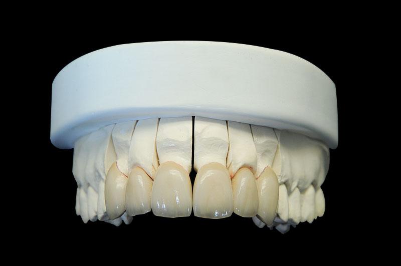 Layered Zirconia